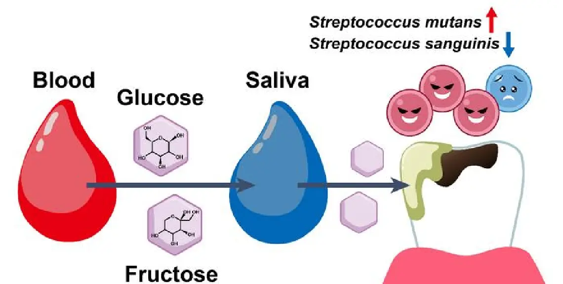 migración del azúcar en sangre en la diabetes afecta el desarrollo de caries