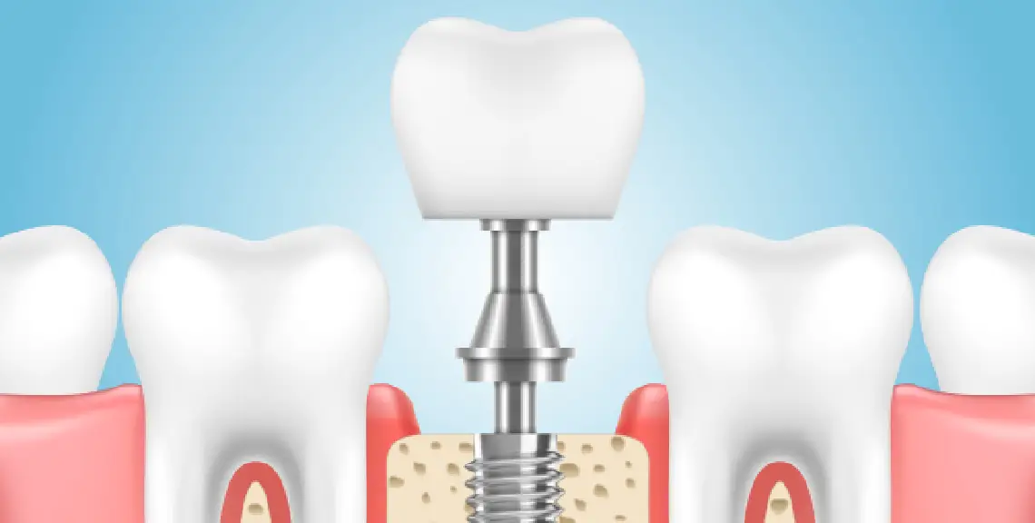 estudio implante protésicamente guiado sepa
