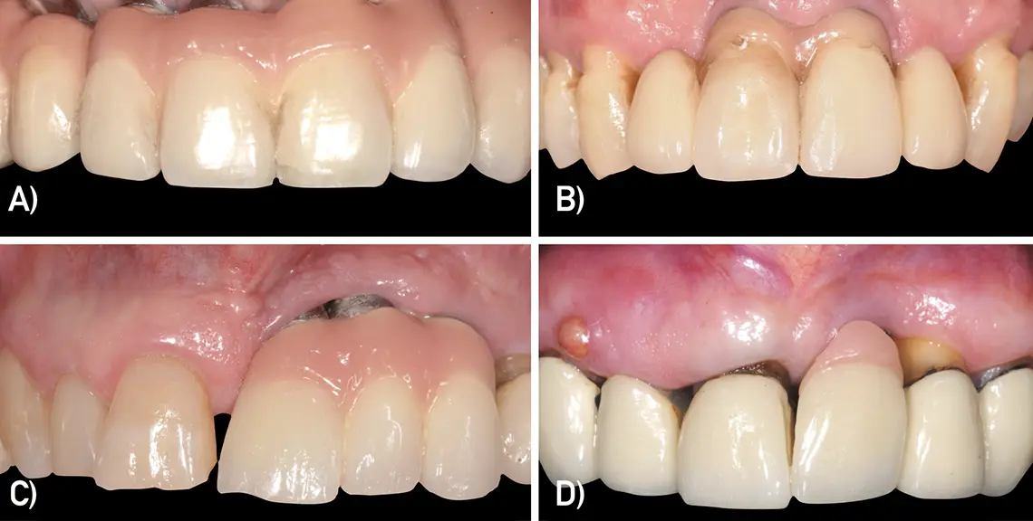 Desafíos actuales en el manejo de las dehiscencias mucosas alrededor de implantes: una revisión narrativa
