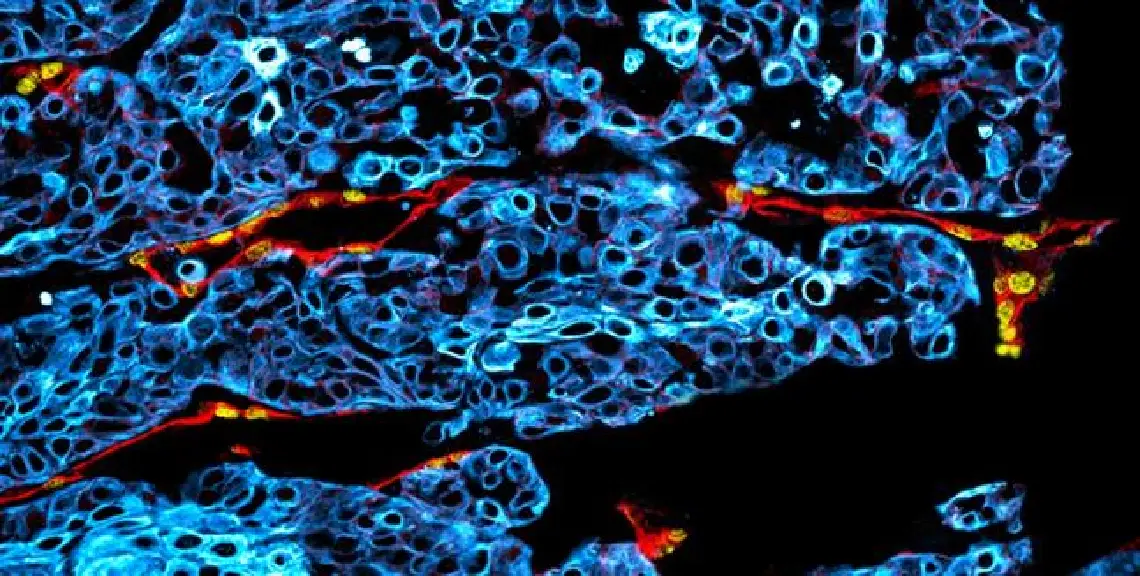Investigación cáncer oral finlandia