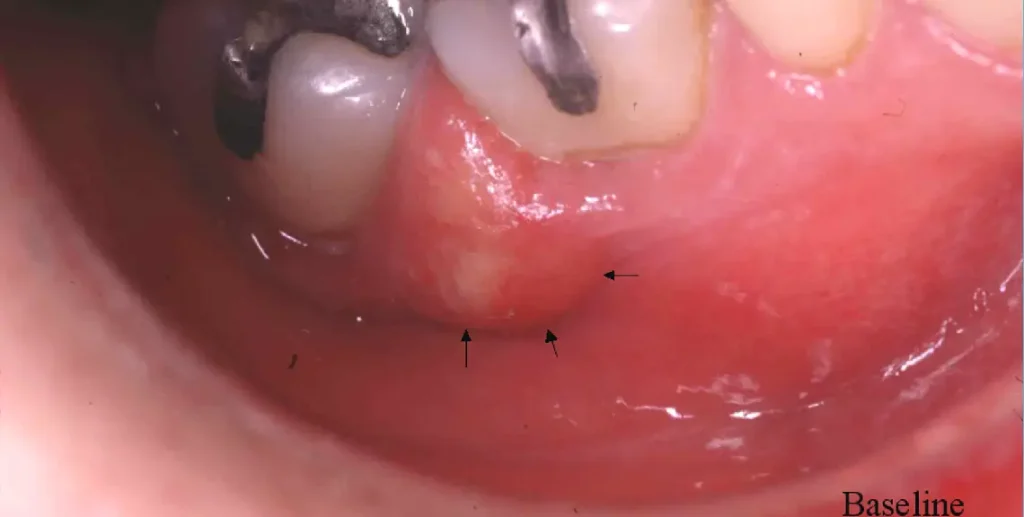 patología periodontal avanzada