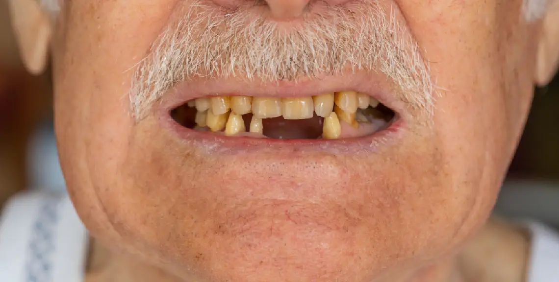 envejecimiento dental