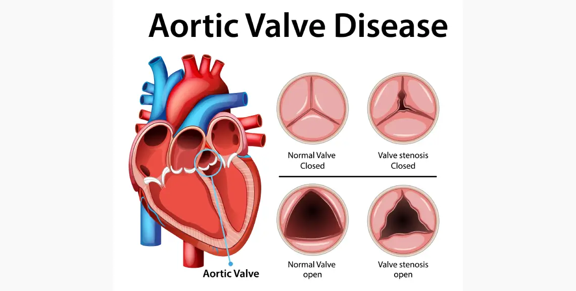 enfermedad periodontal, válvula aórtica cardiaca