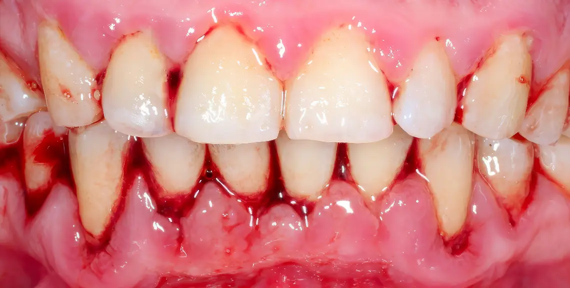 periodontitis