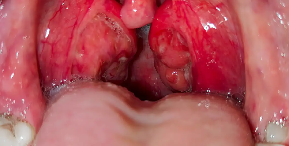 carcinoma de células escamosas orales