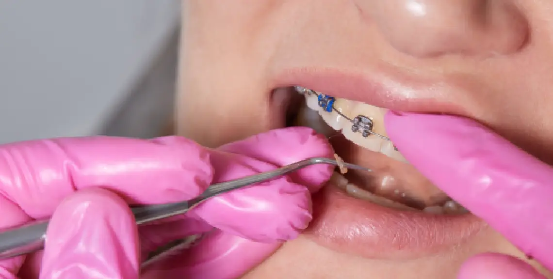 Caries en tratamiento de ortodoncia